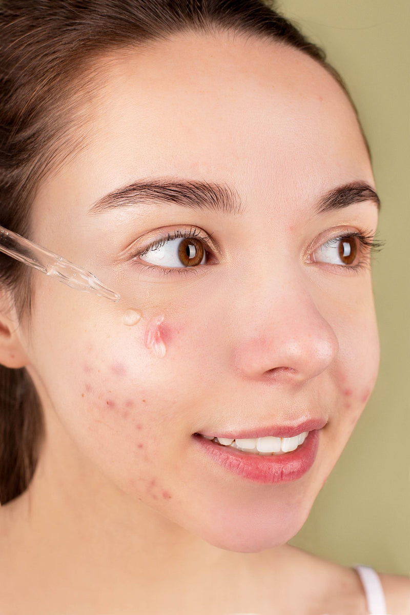Treating acne: gentle and consistent wins